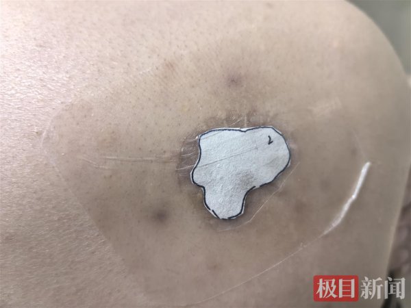 沉赴汉, “核贴”抚平须眉瘢痕之痛