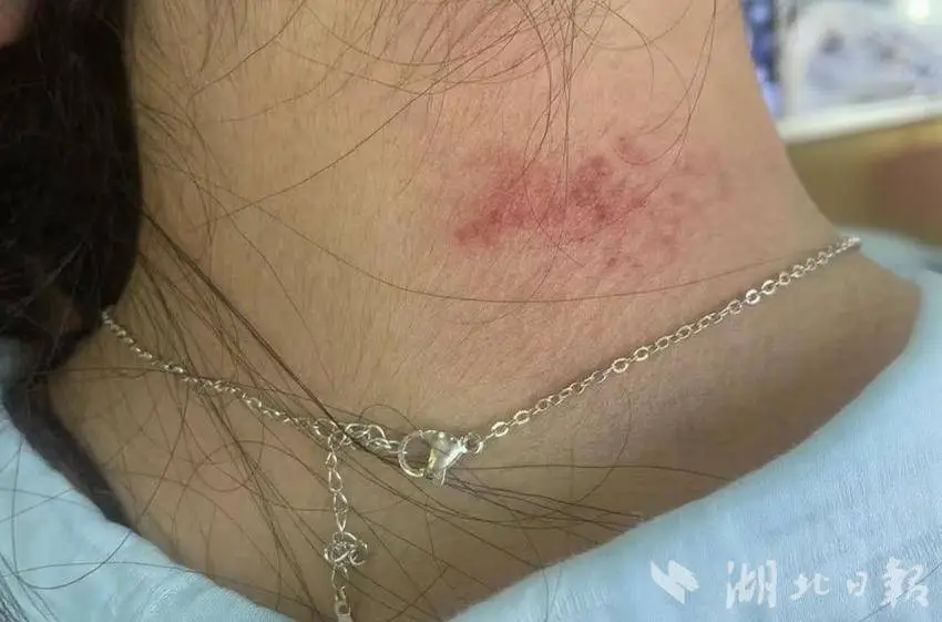 高毒性重金属超标, 有东说念主已中招! 指示: 夏季高发, 不要永劫间构兵